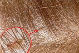 Как избавиться от вшей и гнид в домашних условиях?