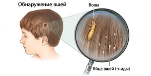 Как избавиться от вшей и гнид в домашних условиях?