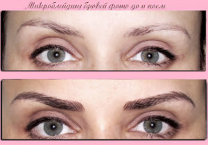 Микроблейдинг до и после